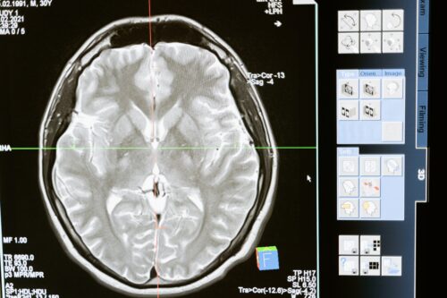 traumatic brain injury TBI auto accident